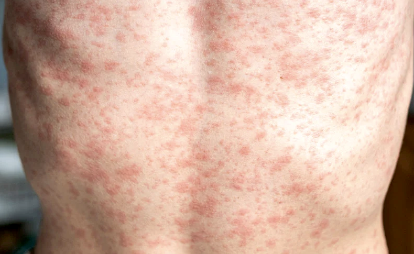 Fourth Measles Case of 2026 Confirmed by Wyoming Department of Health